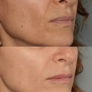 linerase collagen